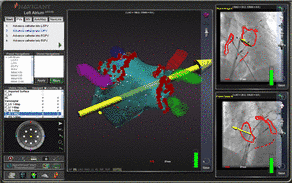 3D-Rekonstruktion des linken Vorhofs. Mit dem gelbem Pfeil kann per Mausklick am Computer die Richtung des Katheters geändert werden.