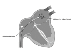 Punktion der Vorhofscheidewand (transseptale Punktion) und Position des Ablationskatheters im linken Vorhof.