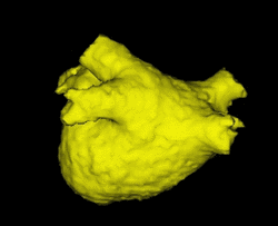 3-D Rekonstruktion des linken Vorhofs und der vier Pulmonalvenen mittels Herz-MRI (Magnet-Resonanz-Tomographie).