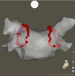 Dreidimensionale Rekonstruktion des linken Vorhofs (Ablationsstellen in rot)
